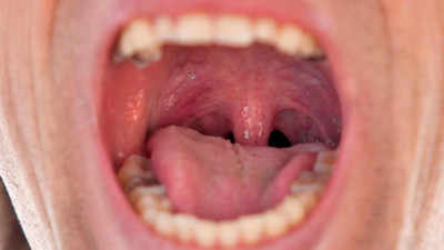 Damakta sararma neden olur?