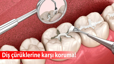 Diş çürüklerine karşı koruma: Fissür örtücü uygulaması nasıl yapılır?