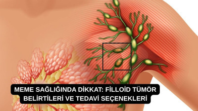 Meme sağlığında dikkat: Filloid tümör belirtileri ve tedavi seçenekleri