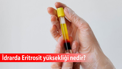 İdrarda Eritrosit yüksekliği nedir, ne anlama gelir, tedavisi?