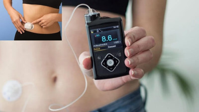 İnsülin pompası nedir? Nasıl kullanılır? Avantajları nelerdir?