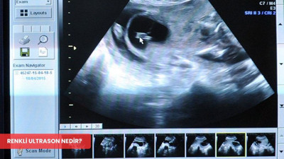 Renkli ultrason nedir? Renkli ultrason ve normal ultrason farkı nedir?