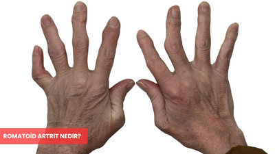 Romatoid artrit nedir? Belirtileri ve tedavi yöntemleri