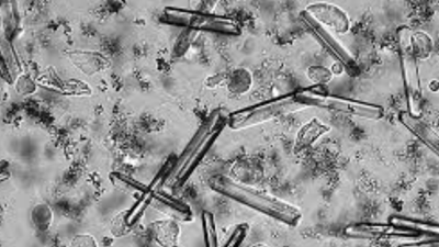 İdrarda kristal yüksekliği neden olur?