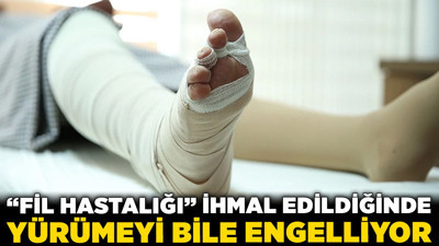 Ciddi tehlike kapıda: "Fil hastalığı” ihmal edildiğinde yürümeyi bile engelliyor!