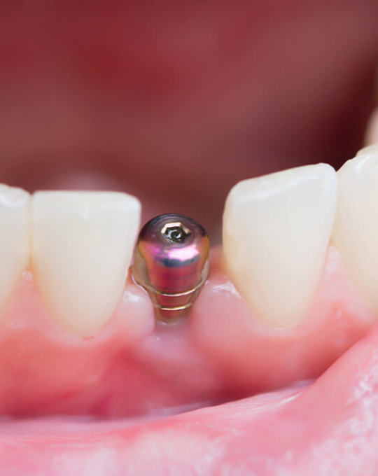 Emekliye "bedava implant" müjdesi mi geliyor? MHP kanun teklifini Meclis'e verdi!