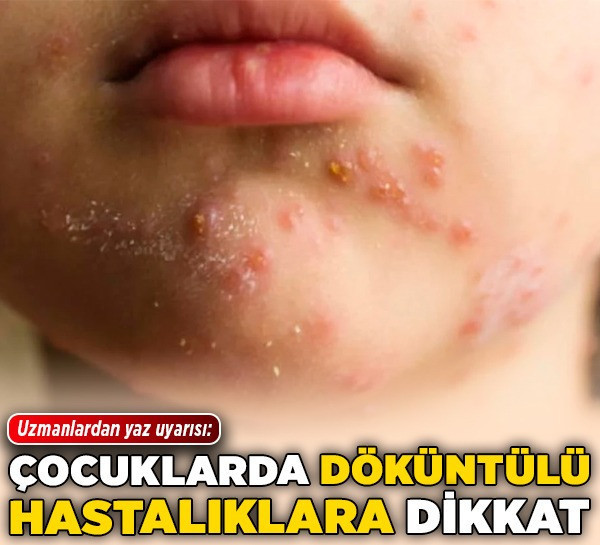 Uzmanlardan yaz uyarısı: Çocuklarda döküntülü hastalıklara dikkat!