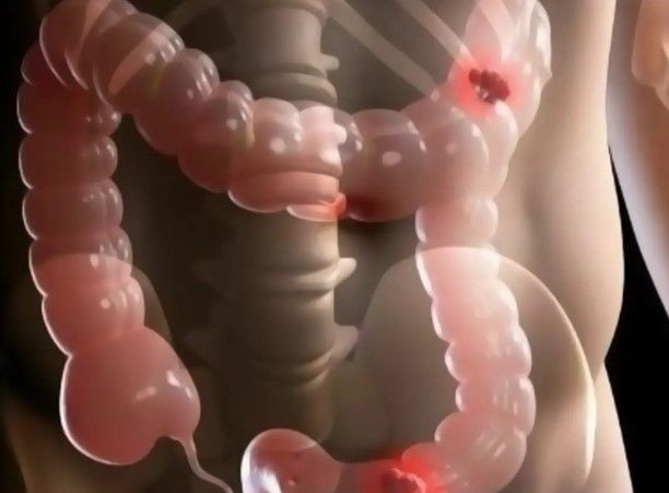 Kolon Kanserinin 5 Belirtisi Neler? - Resim: 5