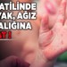 Uzmanlar uyarıyor: Yaz tatilinde el, ayak, ağız hastalığına dikkat!
