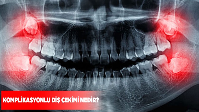 Komplikasyonlu diş çekimi nedir?