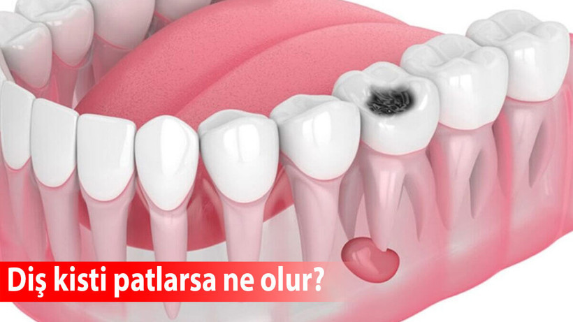 Diş kisti patlarsa ne olur?